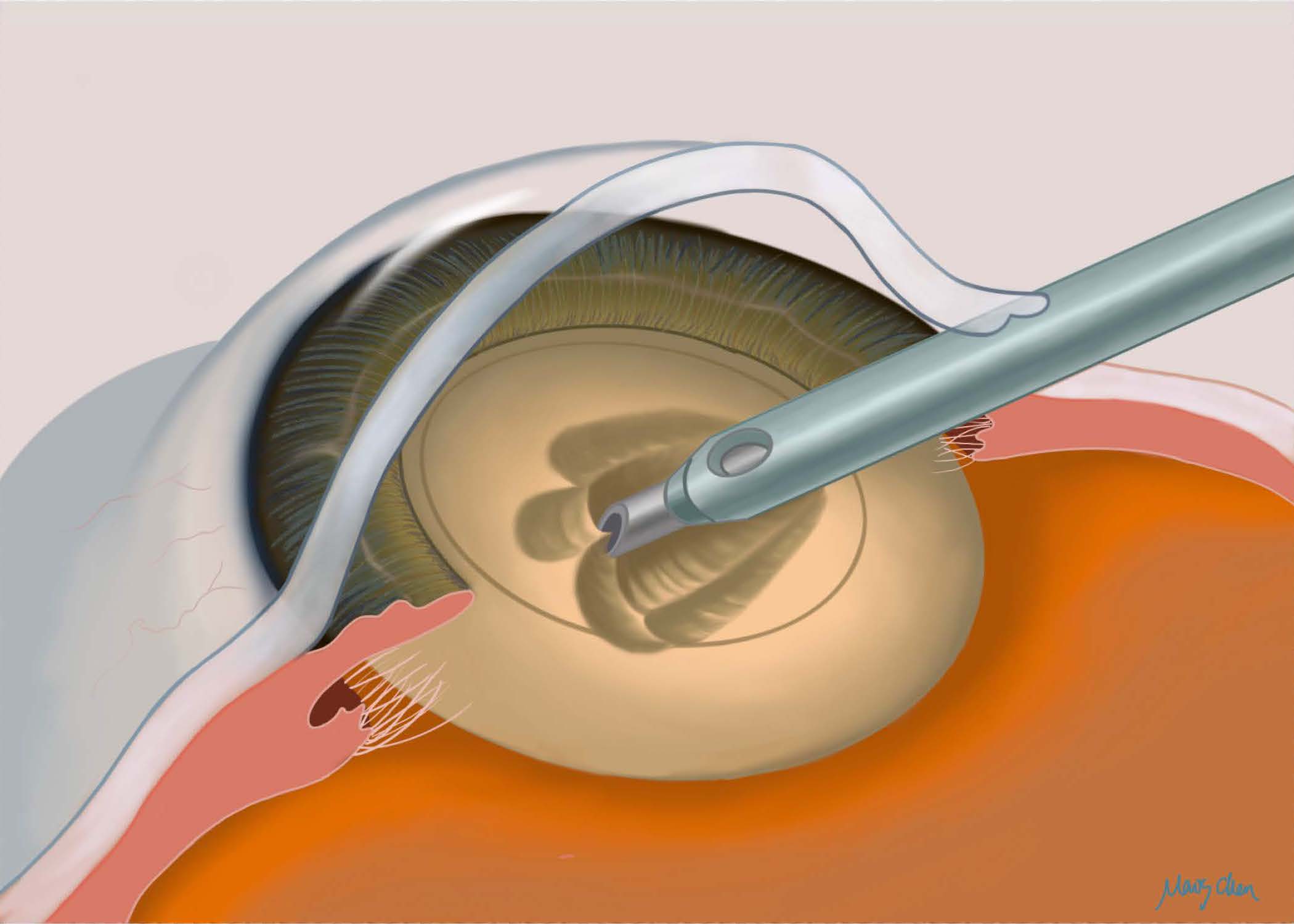 Cataract Surgery
